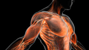 lesiones por levantamiento de pesas